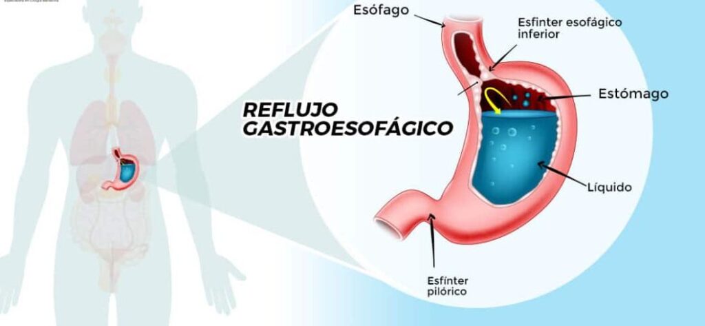 HRM antes de operar el reflujo gastroesofágico