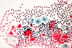 Micrografías teñidas de frotis de Papanicolaou que muestran células estrelladas normales. Una prueba de Papanicolaou, o prueba de Papanicolaou (en honor al inventor de la prueba, George Papanicolaou), es una muestra de tejido del cuello uterino de una mujer que se utiliza para detectar anomalías que puedan indicar una infección o cáncer.