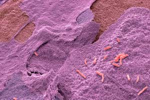 Micrografía electrónica de barrido a color de la bacteria Escherichia coli (E. coli) en las células de la vejiga en una muestra de orina de un paciente con una infección del tracto urinario