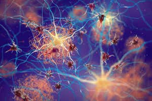 2CE12PN forma placas de amiloide entre las neuronas. Beta-amiloide interrumpe la función de las células nerviosas en los cerebros de la enfermedad de Alzheimer
