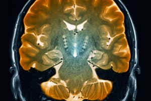 Resonancias magnéticas cerebrales de pacientes con enfermedad de Parkinson