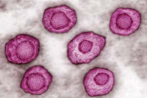 El virus de Epstein-Barr causa fiebre glandular y está cada vez más relacionado con la esclerosis múltiple