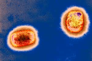Partículas del virus de la viruela del mono capturadas por micrografías electrónicas de transmisión de color
