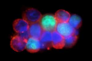 Células circulantes de cáncer de mama. Micrografías de fluorescencia de un panel de células tumorales circulantes (CTC, rojo) y leucocitos (verde) de la sangre de una paciente con cáncer de mama.  Los CTC son un foco importante de la investigación del cáncer porque proporcionan un objetivo clave para nuevos enfoques terapéuticos. Mediante la identificación de adaptaciones moleculares y mutaciones genéticas que permiten que las CTC se propaguen (metástasis), es posible desarrollar estrategias para detener el cáncer metastásico paciente por paciente.
