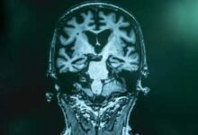 Enfermedad de Alzheimer y MRI; Existente bajo el ID de Shutterstock 1025800153; Orden de compra: -; Trabajo: -; Cliente: -; Otro: -