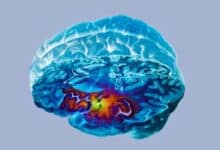 Imagen de resonancia magnética (MRI) 3D del cerebro de un hombre de 65 años después de un derrame cerebral.El naranja representa áreas de tejido muerto