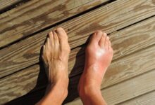 Weight and Gout Risk