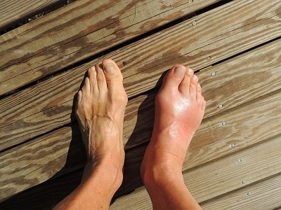Weight and Gout Risk