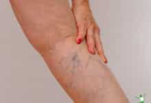 woman using natural treatment for varicose veins in lower right leg