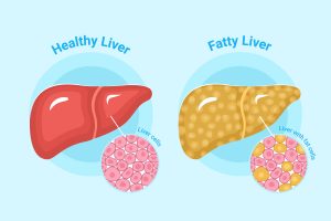 Tabla de dieta india para hepatomegalia PDF (Cómo reducir la inflamación del hígado)