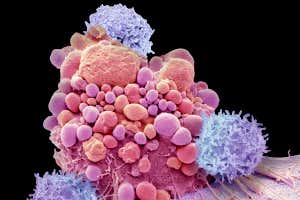 Células T y células de cáncer cerebral.  Micrografía electrónica de barrido en color compuesta (SEM) de células T y una célula de cáncer cerebral apoptótica.  Las células T son un componente del sistema inmunológico del cuerpo.  La terapia de células T CAR toma células T de la sangre de un paciente con cáncer y las modifica para reconocer una proteína específica que se encuentra en las células tumorales del paciente.  Cuando se vuelven a introducir al paciente, las células T encuentran y destruyen las células tumorales.  La forma más nueva de terapia con células CAR T, ahora en ensayos clínicos, utiliza células T de