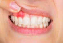 Cuida tu salud bucodental para evitar problemas periodontales 25 problemas periodontales