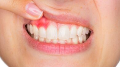 Cuida tu salud bucodental para evitar problemas periodontales 7 problemas periodontales
