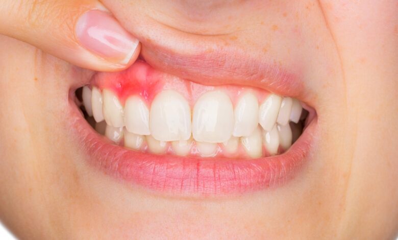 Cuida tu salud bucodental para evitar problemas periodontales 1 problemas periodontales