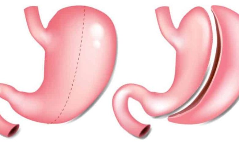 Manga Gástrica vs Otros Procedimientos Bariátricos 1 Manga Gástrica Procedimientos Bariátricos